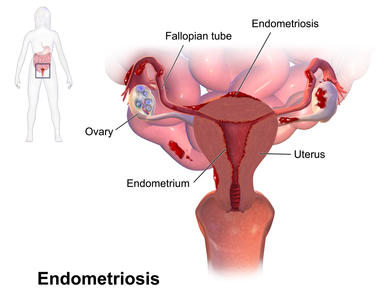 Instituto Europeo de Fertilidad Diagnostico Endometriosis.png