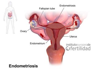 endometriosis-tratamiento-y-diagnostico-para-la-fertilidad.jpg