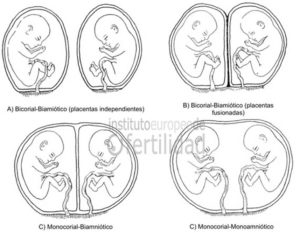 fecundacion-in-vitro-crecimiento-desigual-gemelos-2.jpg